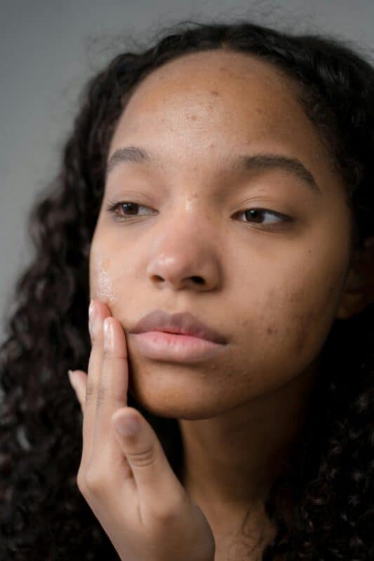 Concerns Acne Scars